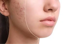 اسکار جوش و راهکارهایی برای درمان آن