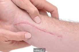 اسکار زخم و راه‌های درمان آن