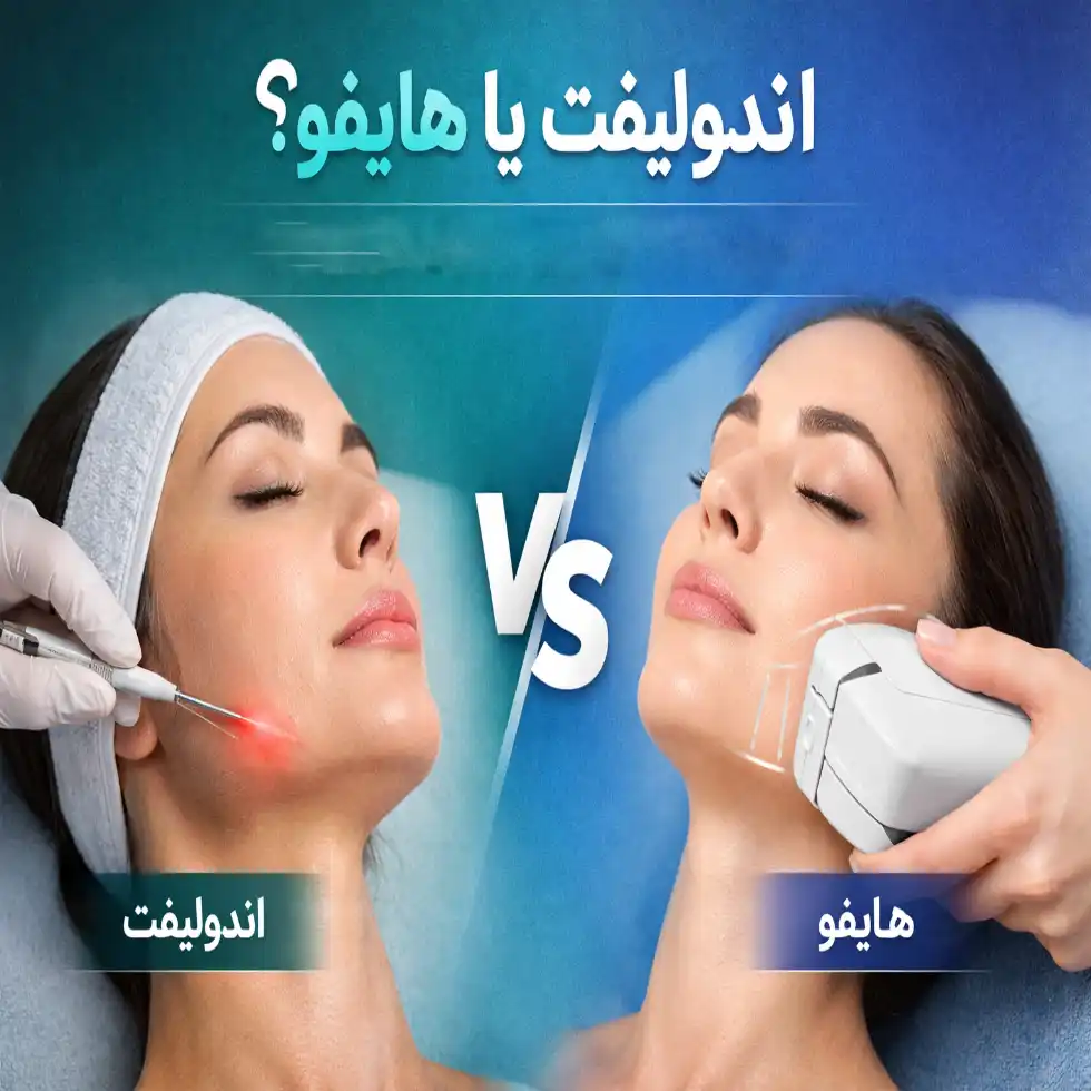 اندولیفت یا هایفو