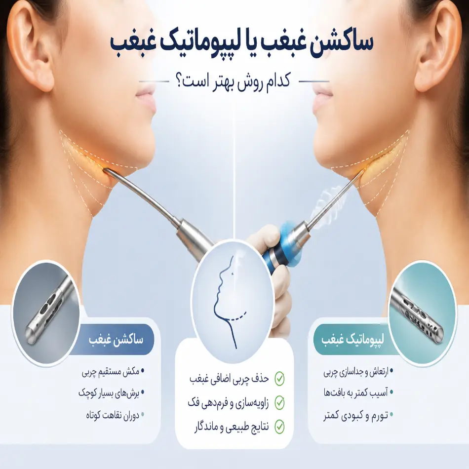ساکشن غبغب یا لیپوماتیک غبغب
